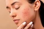 pimples, skin, 10 ways to get rid of pimples at home, Healthy food