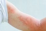 dermatological symptoms, dermatological symptoms, dermatological symptoms could be a sign for covid 19 infection, Medical professionals