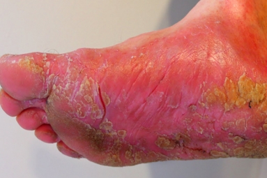 Top 7 Home Remedies for Athlete's Foot Top 7 Home Remedies for Athlete's Foot